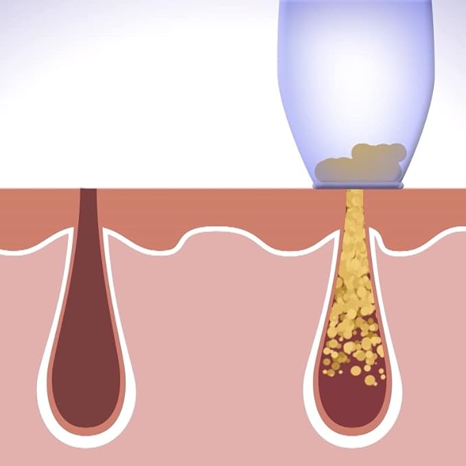 Purificateur de Peau Visage – Anti-Points Noirs