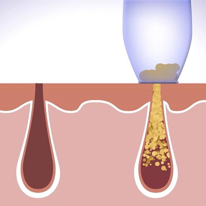 Purificateur de Peau Visage – Anti-Points Noirs